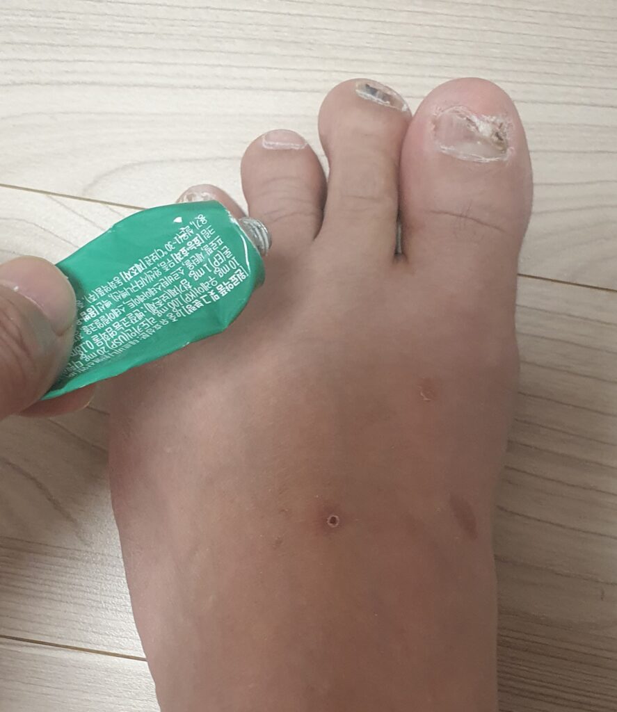 당뇨 발 무좀, 약 부작용이 두려워 4년을 버틴 환자의 현실적인 발 관리 습관 가이드 1 EBB09C2 887x1024 1
